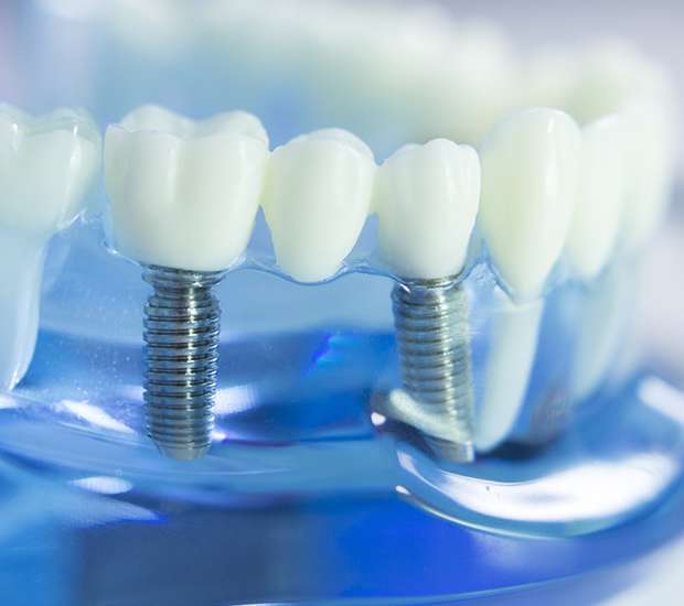 North Hollywood Dental Implants